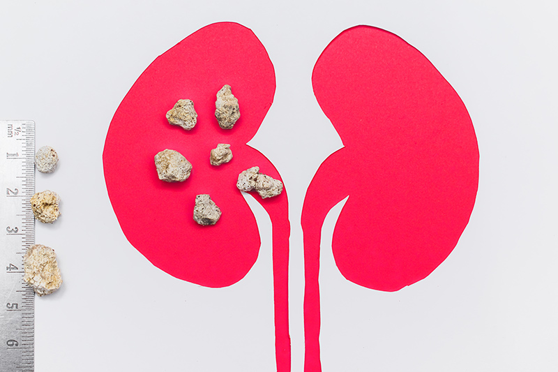 How Are Kidney Stones Removed? Common Treatment Options Explained